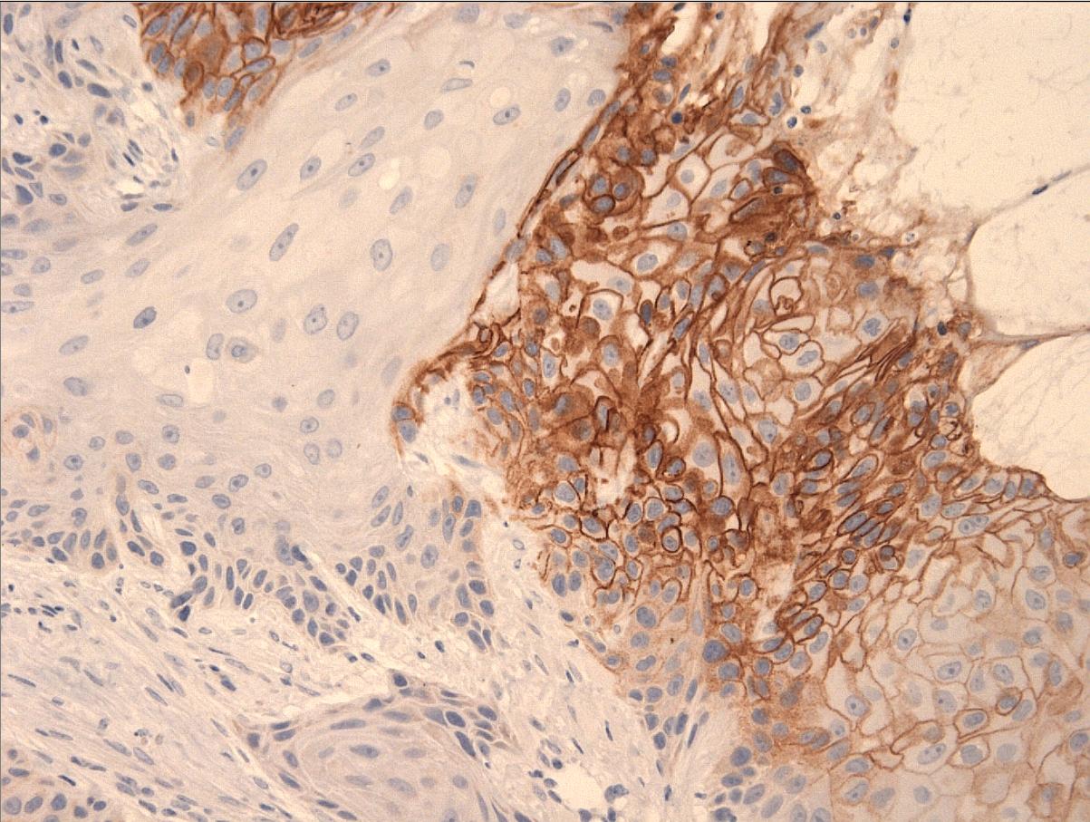 Image of CA9 IHC for hypoxia screening